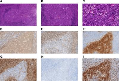 Case report: Clinicopathological and molecular characteristics of pediatric-type follicular lymphoma